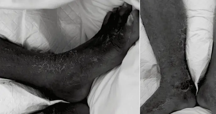 Bacteria marina causa infección en la pierna de un hombre de 75 años con diabetes y psoriasis 