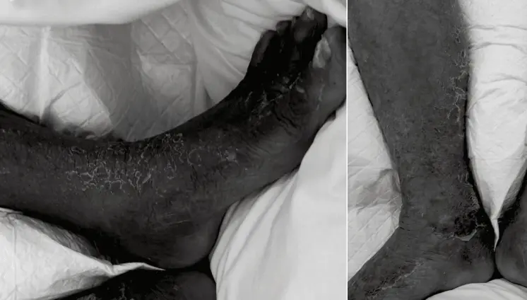 Bacteria marina causa infección en la pierna de un hombre de 75 años con diabetes y psoriasis 