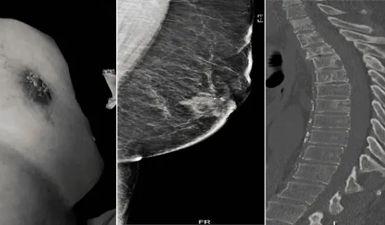 Paciente masculino fue diagnosticado con cáncer mamario avanzado: Dolor lumbar fue el síntoma inicial
