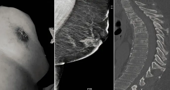 Paciente masculino fue diagnosticado con cáncer mamario avanzado: Dolor lumbar fue el síntoma inicial