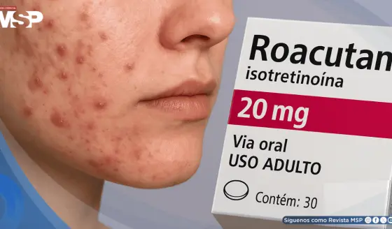 ¿Roacután para el acné severo? Esto es lo que debes saber de automedicarse con Isotretinoína