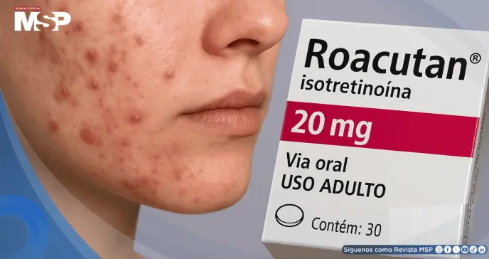 ¿Roacután para el acné severo? Esto es lo que debes saber de automedicarse con Isotretinoína