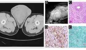 Angiomixoma agresivo escrotal confundido con hidrocele en un paciente masculino de 64 años