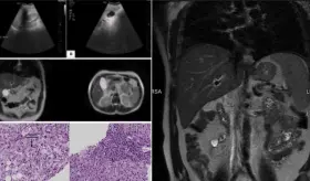 Consumo prolongado de vinagre de manzana desencadena leve daño hepático en paciente