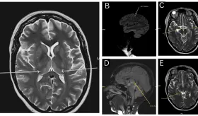 Vómitos persistentes, ataxia y trastornos visuales: Diagnóstico de Encefalopatía Wernicke no alcohólica