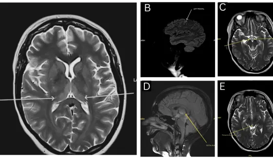 Vómitos persistentes, ataxia y trastornos visuales: Diagnóstico de Encefalopatía Wernicke no alcohólica