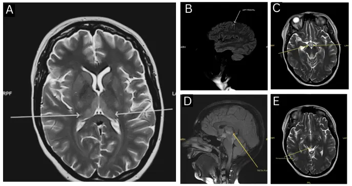 Vómitos persistentes, ataxia y trastornos visuales: Diagnóstico de Encefalopatía Wernicke no alcohólica