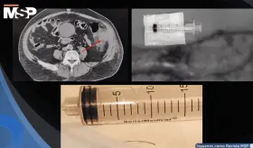 Perforación colónica por espina de pescado se presentó como un cuadro similar a cáncer