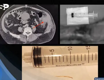 Perforación colónica por espina de pescado se presentó como un cuadro similar a cáncer