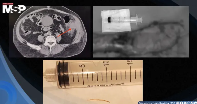 Perforación colónica por espina de pescado se presentó como un cuadro similar a cáncer