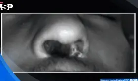 Paciente con VIH sin tratamiento sufre dolor dental y destrucción del tabique por delirio de parasitosis