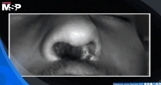 Paciente con VIH sin tratamiento sufre dolor dental y destrucción del tabique por delirio de parasitosis