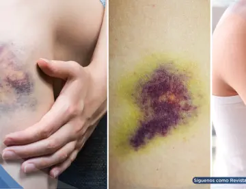 Así actúa un moretón en tu cuerpo: por qué cambia de color, cuánto dura y cuándo requiere atención médica