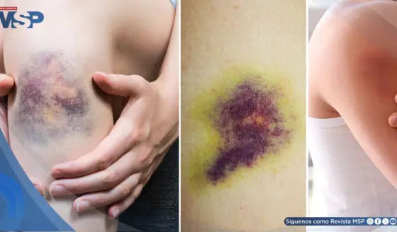 Así actúa un moretón en tu cuerpo: por qué cambia de color, cuánto dura y cuándo requiere atención médica