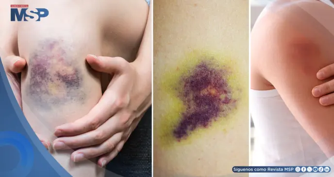Así actúa un moretón en tu cuerpo: por qué cambia de color, cuánto dura y cuándo requiere atención médica