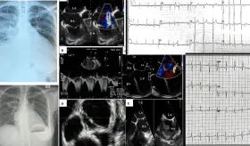 Descubren incidentalmente una rara malformación cardíaca en mujer con VIH y severa disfunción ventricular