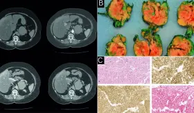 Brote psicótico e hipertensión refractaria como presentación de carcinoma adrenocortical oncocítico 