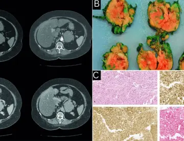 Brote psicótico e hipertensión refractaria como presentación de carcinoma adrenocortical oncocítico 