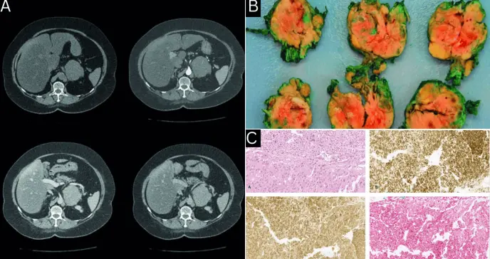 Brote psicótico e hipertensión refractaria como presentación de carcinoma adrenocortical oncocítico 