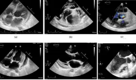 Bacteria oral causa endocarditis infecciosa en las cuatro válvulas del corazón en mujer de 42 años