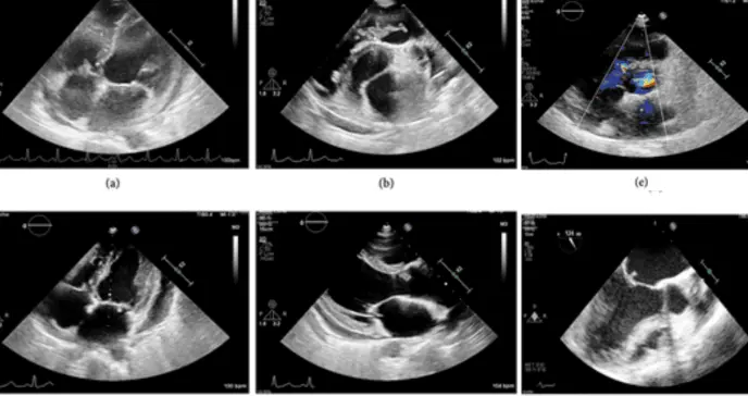 Bacteria oral causa endocarditis infecciosa en las cuatro válvulas del corazón en mujer de 42 años