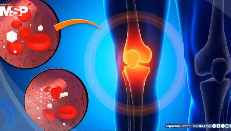 La diabetes estaría relacionada con el dolor de rodilla: ¿Qué hacer y cómo aliviar la molestia? La diabetes estaría relacionada con el dolor de rodilla: ¿Qué hacer y cómo aliviar la molestia?