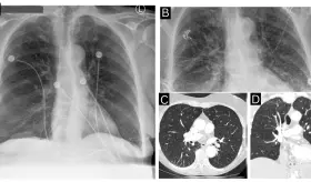 Picadura de garrapata provoca miocardiopatía de Takotsubo y shock cardiogénico por babesiosis