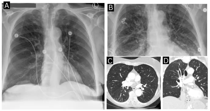 Picadura de garrapata provoca miocardiopatía de Takotsubo y shock cardiogénico por babesiosis