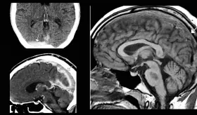 Anticonceptivos orales inducen trombosis venosa cerebral: Cefalea persistente como signo inicial