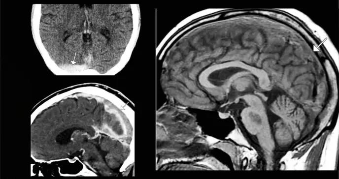Anticonceptivos orales inducen trombosis venosa cerebral: Cefalea persistente como signo inicial