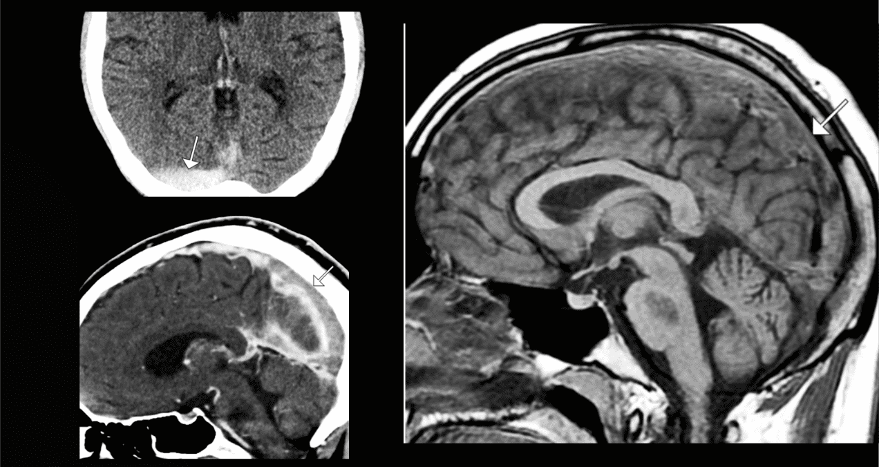 Anticonceptivos orales inducen trombosis venosa cerebral: Cefalea persistente como signo inicial