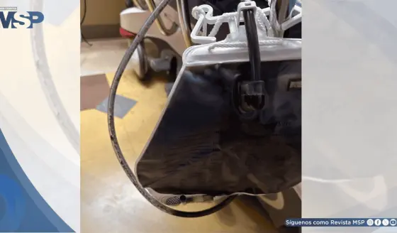 Coloración púrpura de la orina como signo de infección urinaria en paciente con catéter permanente