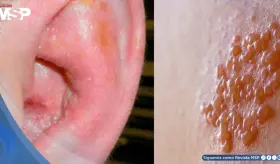 Joven con VIH sin tratar desarrolla pérdida auditiva y parálisis facial por virus de la varicela zóster