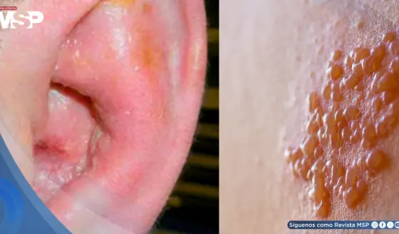 Joven con VIH sin tratar desarrolla pérdida auditiva y parálisis facial por virus de la varicela zóster