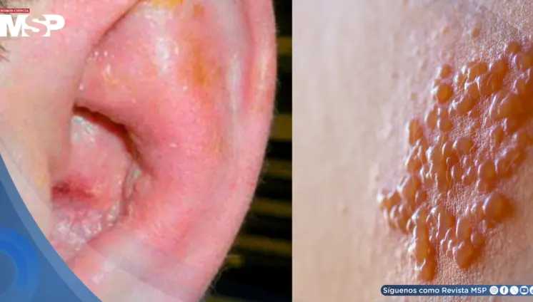 Joven con VIH sin tratar desarrolla pérdida auditiva y parálisis facial por virus de la varicela zóster