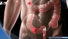 Los riesgos del cáncer colorrectal temprano podrían acumularse desde la infancia, según estudio 