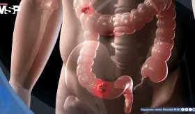 Los riesgos del cáncer colorrectal temprano podrían acumularse desde la infancia, según estudio 