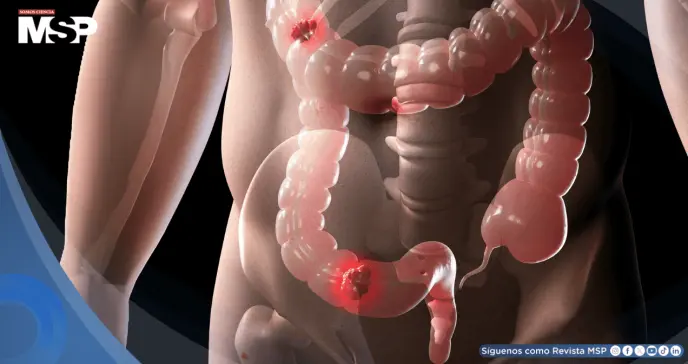 Los riesgos del cáncer colorrectal temprano podrían acumularse desde la infancia, según estudio 