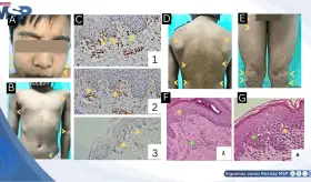 Lesiones hipopigmentadas persistentes como presentación de micosis fungoides en paciente de 7 años