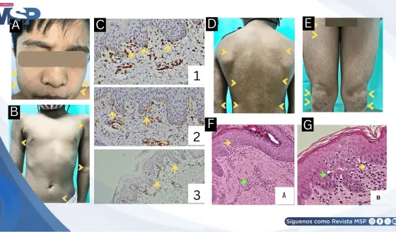 Lesiones hipopigmentadas persistentes como presentación de micosis fungoides en paciente de 7 años