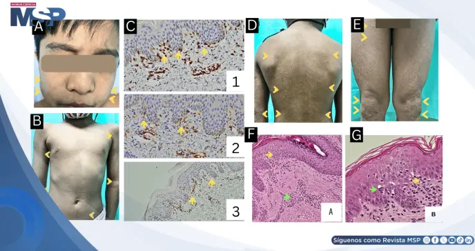 Lesiones hipopigmentadas persistentes como presentación de micosis fungoides en paciente de 7 años