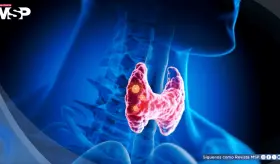 ¿Hipertiroidismo o hipotiroidismo? Cómo reconocer sus síntomas y diferenciarlos