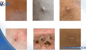 Vesículas dolorosas en genitales de hombre de 23 años resultan ser viruela del mono pese a estar vacunado