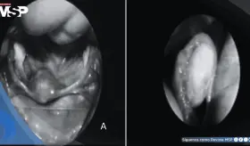 Síndrome de Swyer y gonadoblastoma se manifestó con amenorrea primaria en joven de 16 años