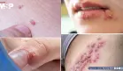 Verrugas por VPH y herpes genital: ¿Por qué no son lo mismo y cómo diferenciarlas?