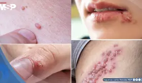 Verrugas por VPH y herpes genital: ¿Por qué no son lo mismo y cómo diferenciarlas?