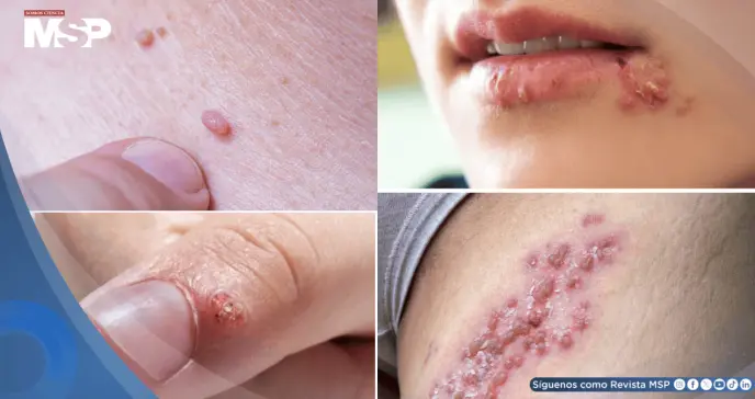 Verrugas por VPH y herpes genital: ¿Por qué no son lo mismo y cómo diferenciarlas?