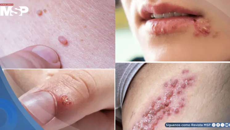 Verrugas por VPH y herpes genital: ¿Por qué no son lo mismo y cómo diferenciarlas?