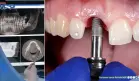 Implantes orales metálicos estarían aumentando el riesgo de enfermedades, según estudios 