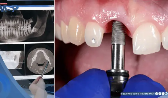 Implantes orales metálicos estarían aumentando el riesgo de enfermedades, según estudios 